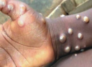 ලොවම බිය ගැන් වූ මාරාන්තික මංකිපොක්ස් ගැන සෞඛ්ය අමාත්යාංශයෙන් නිවේදනයක්